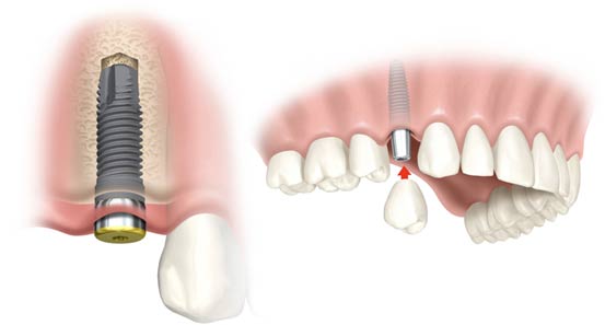 dental implant vancouver dentist dental implant vancouver dentist